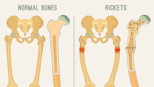 hậu quả bị thiếu vitamin D