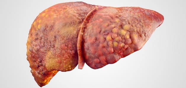 Xơ gan là gì? Đây là một bệnh lý vô cùng nguy hiểm đối với sức khỏe