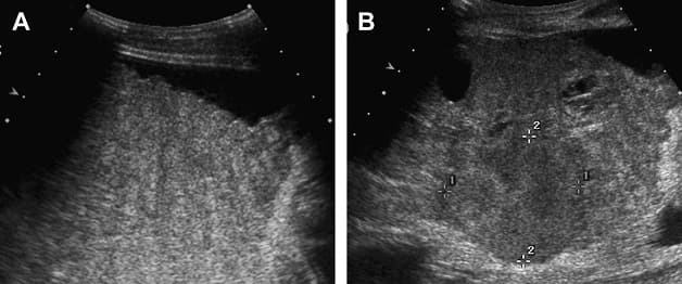 Siêu âm gan là phương pháp chẩn đoán có tính chính xác cao