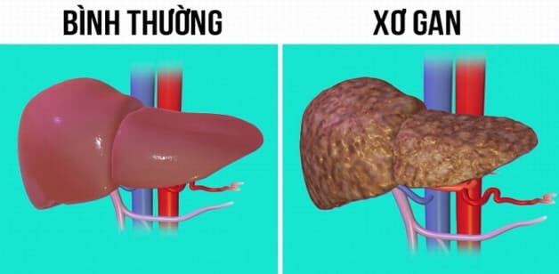 Xơ hóa gan là khi các tế bào gan bị thương tổn