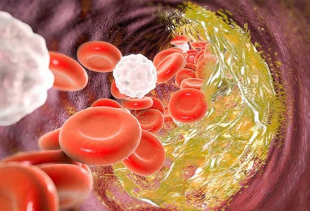 Xơ vữa động mạch tim là gì 