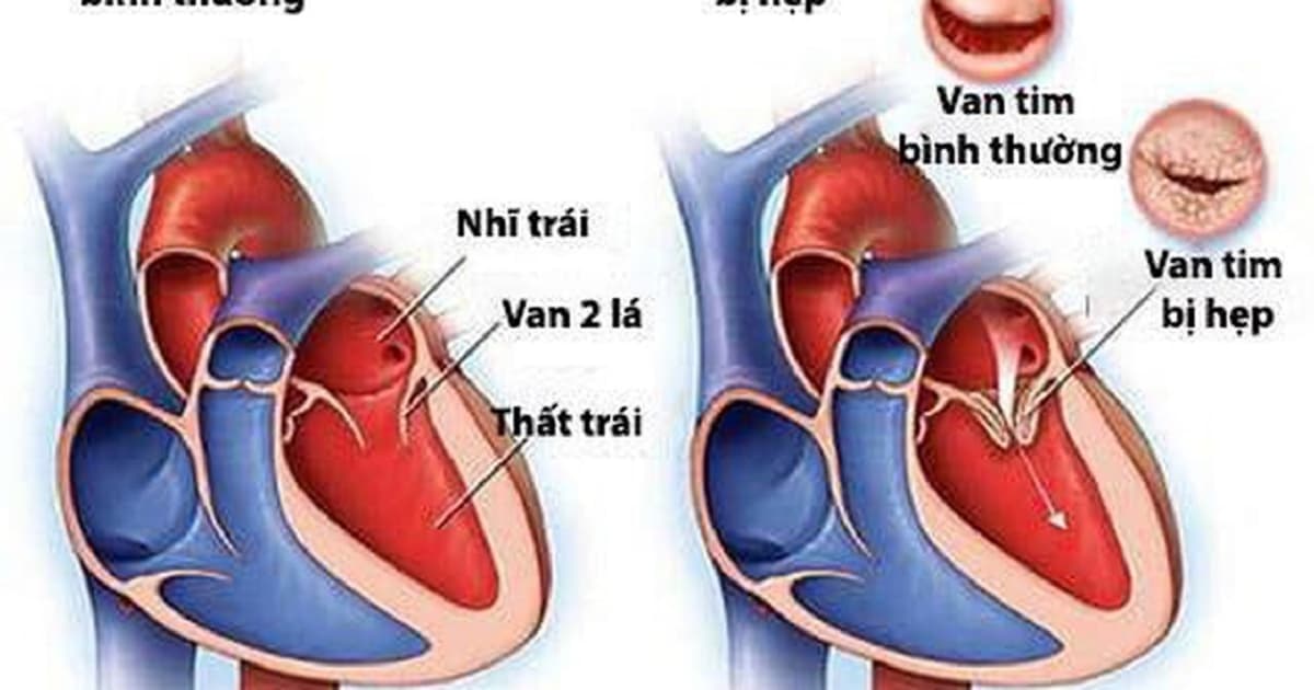 Hiện tượng hẹp van tim: Nguyên nhân và biến chứng