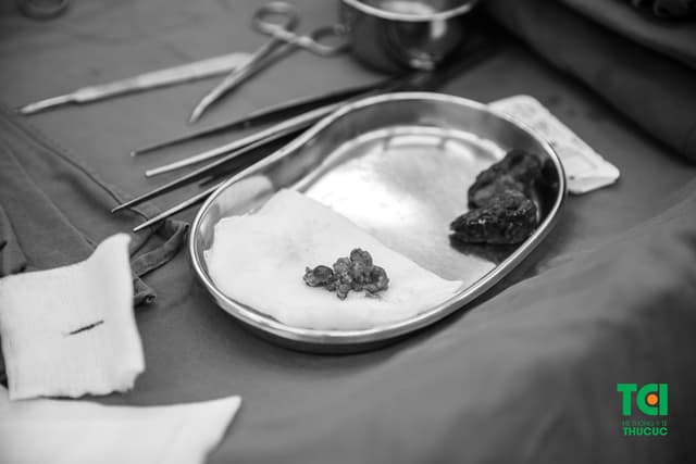 Phẫu thuật ung thư tuyến giáp tại Bệnh viện Thu Cúc