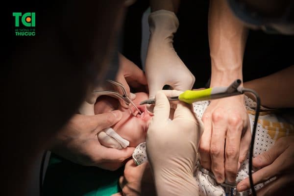 Phẫu thuật dính thắng lưỡi chỉ diễn ra trong khoảng 5 phút và không gây biến chứng gì cho trẻ