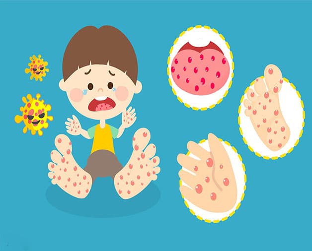 Dấu hiệu nhận biết bệnh tay chân miệng ở trẻ