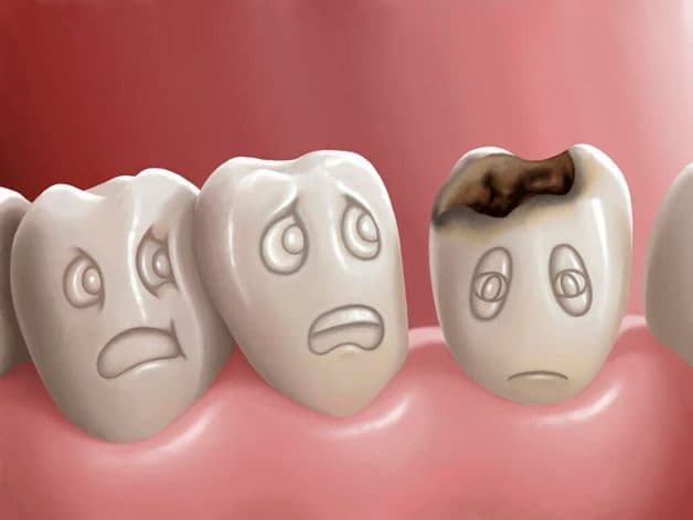 Sâu răng là một trong những nguyên nhân phổ biến gây đau răng ở trẻ.