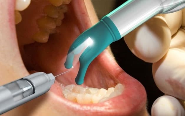 Chữa tủy răng có đau không? Trước khi lấy tủy, bác sĩ sẽ gây tê nhằm kiểm soát cơn đau cho bệnh nhân.