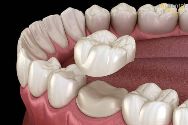 Chụp sứ răng hàm là phương pháp sử dụng lớp vỏ sứ có màu sắc và hình dáng tự nhiên để bọc bên ngoài răng thật