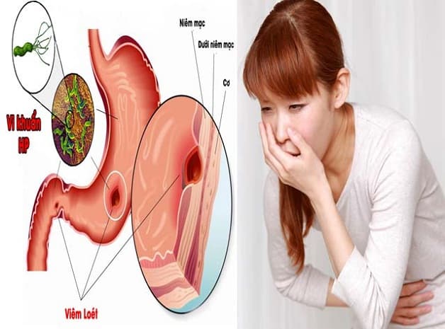 Vi khuẩn Hp gây viêm, loét và ung thư dạ dày