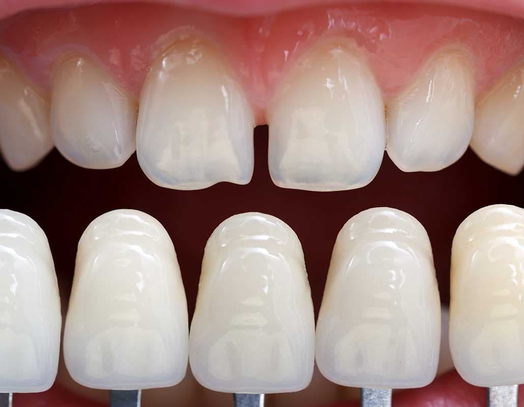 Dán Veneer nhựa composite 