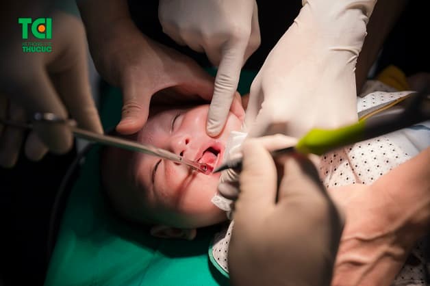 Phẫu thuật dính thắng lưỡi cho trẻ tại bệnh viện ĐKQT Thu Cúc