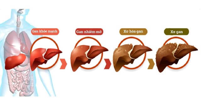 Gan nhiễm mỡ có nguy hiểm không và cách phòng tránh