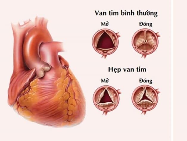 Hẹp van tim có nhiều dạng và nhiều mức độ khác nhau 