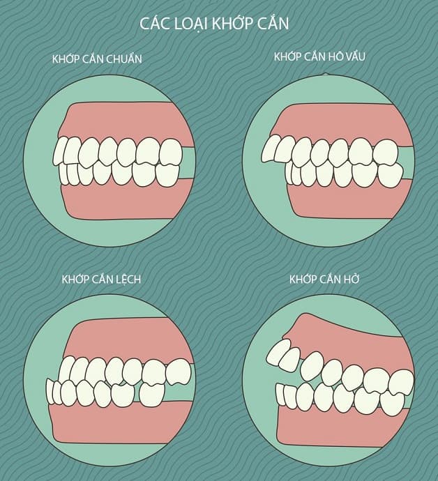 Các trường hợp lệch khớp phổ biến 