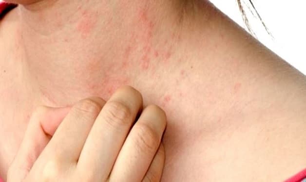 Gan không hoạt động tốt gây nóng gan nổi mụn ngứa