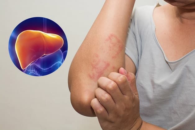 Người có vấn đề về gan thường có những cơn ngứa râm ran