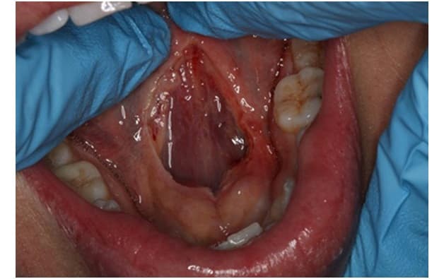 Sau phẫu thuật dính thắng lưỡi ở người lớn