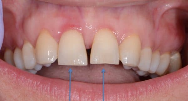 Răng cửa là những răng nằm ở phía trước