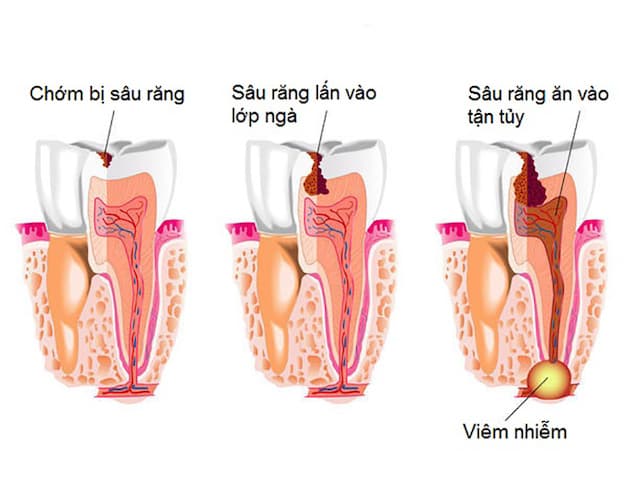 Bệnh sâu răng là nguyên nhân gây viêm tủy răng hàng đầu.