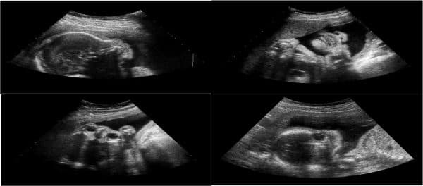 Siêu âm lần cuối trước khi sinh cần xét nghiệm những gì?