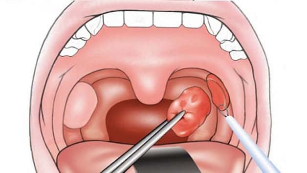 cách chữa sỏi amidan