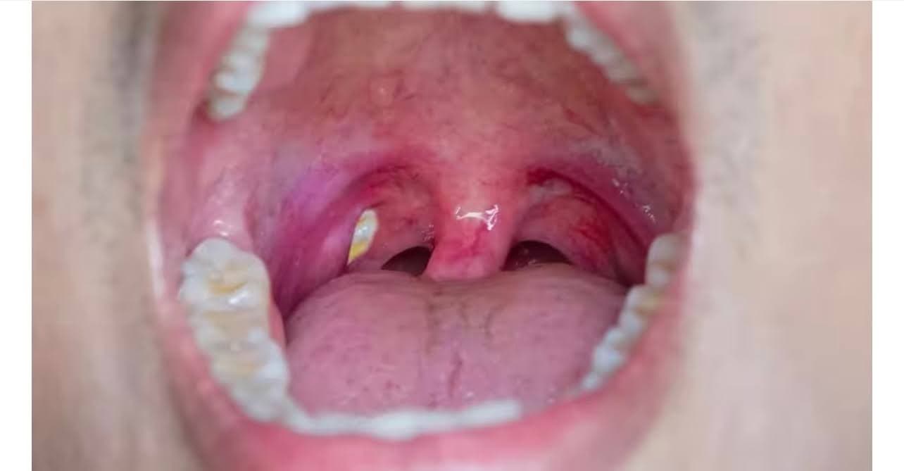 sỏi amidan có tự hết không