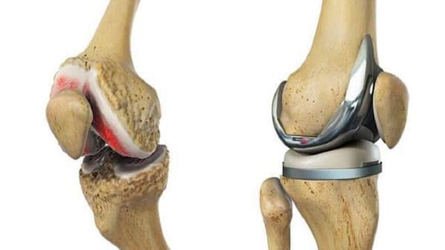 Thay khớp gối khi nào thích hợp nhất