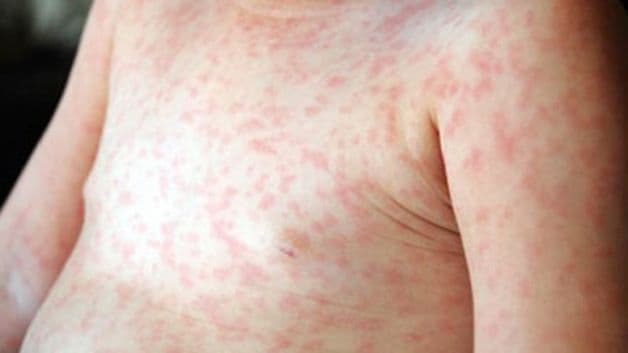 Nổi mẩn đỏ là một loại tổn thương trên da phổ biến và thường gặp ở trẻ nhỏ.