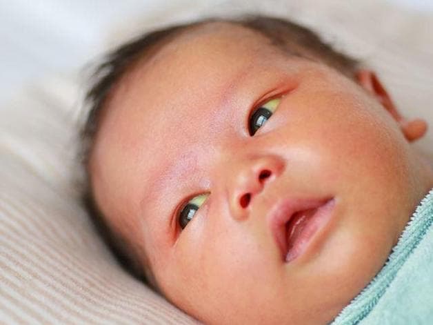 Mẹ nên đưa trẻ đến gặp bác sĩ khi thấy lòng trắng của mắt, vùng da ở ngực, bụng, cánh tay, lòng bàn tay hoặc chân, lòng bàn chân của bé có màu vàng đậm.