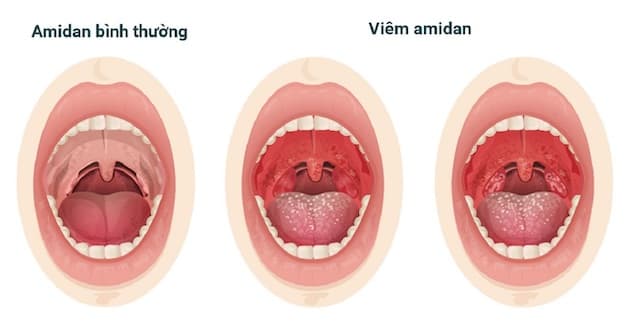 Triệu chứng điển hình của viêm nhiễm amidan ở trẻ chính là sưng và tấy đỏ.