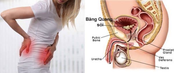 Triệu chứng sỏi bàng quang cụ thể