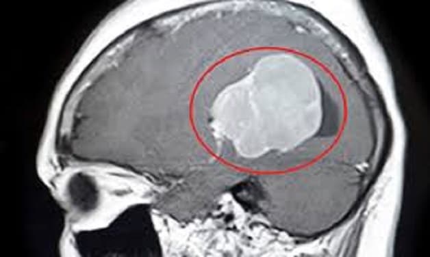 u não gây đau đầu sau gáy và chóng mặt