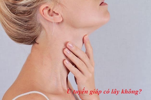 U tuyến giáp có lây không?