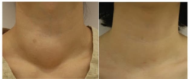 Tìm hiểu u tuyến giáp là gì?