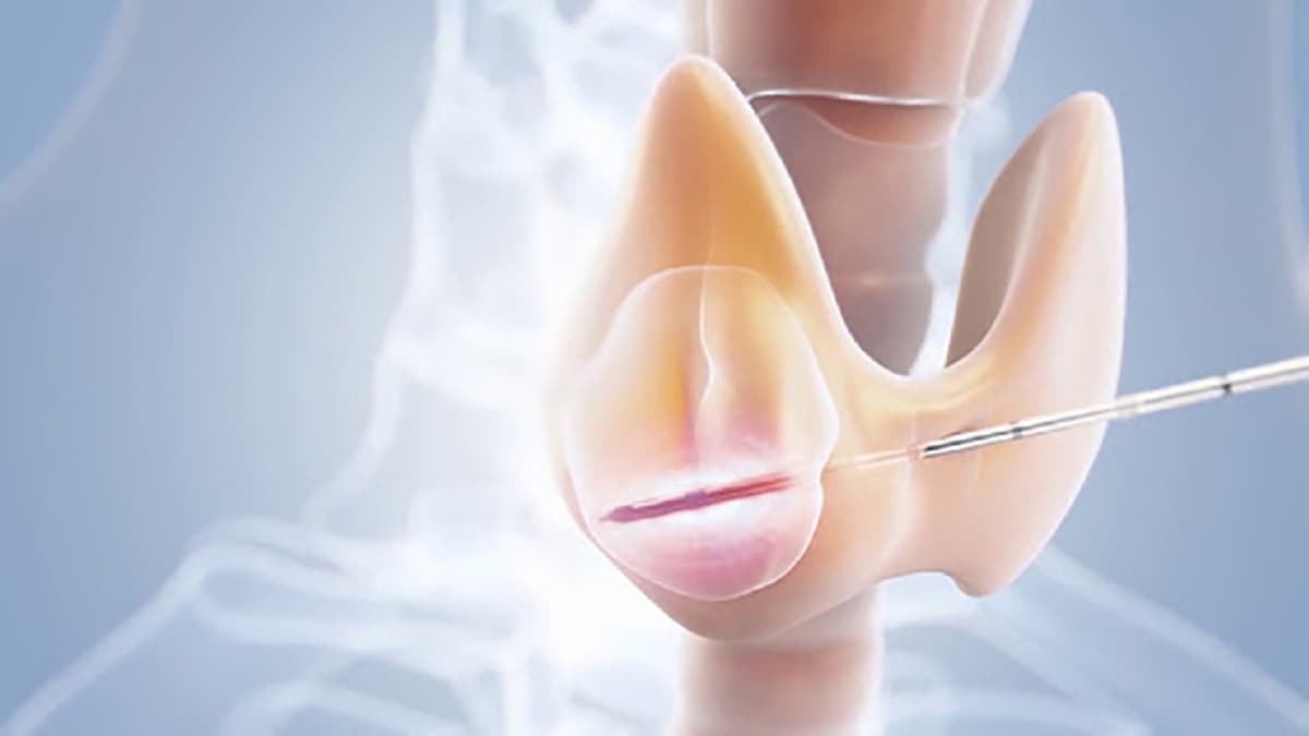U tuyến giáp lành tính có nên mổ không và giải pháp điều trị tối ưu