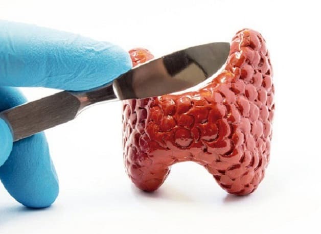 Điều trị u tuyến giáp vôi hóa phụ thuộc vào tính chất của khối u