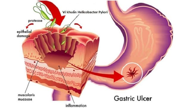 Vi khuẩn Hp có thể tồn tại vĩnh viễn dưới lớp niêm mạc dạ dày con người