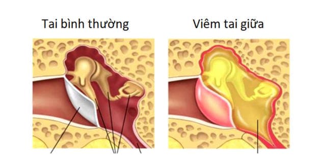 hình ảnh viêm tai giữa