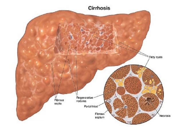 Xơ gan bệnh học theo từng hình thái