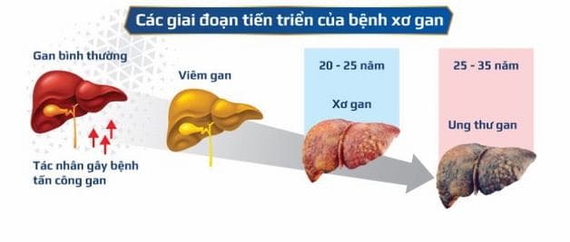 Xơ gan bệnh học có thể tiến triển thành ung thư gan