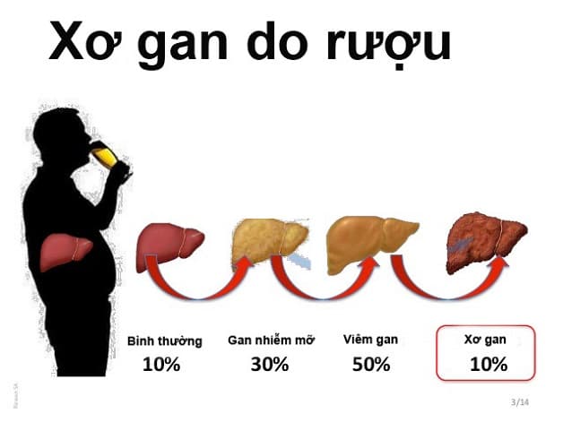 Cơ chế xơ gan do rượu