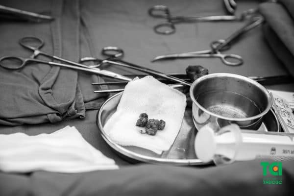 nên mổ u tuyến giáp ở đâu tốt nhất