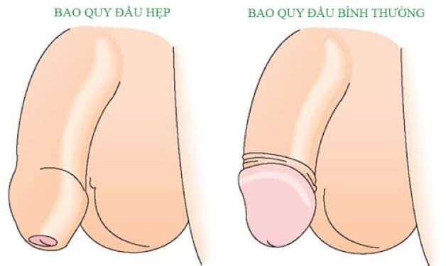 Hiên tượng hẹp bao quy đầu