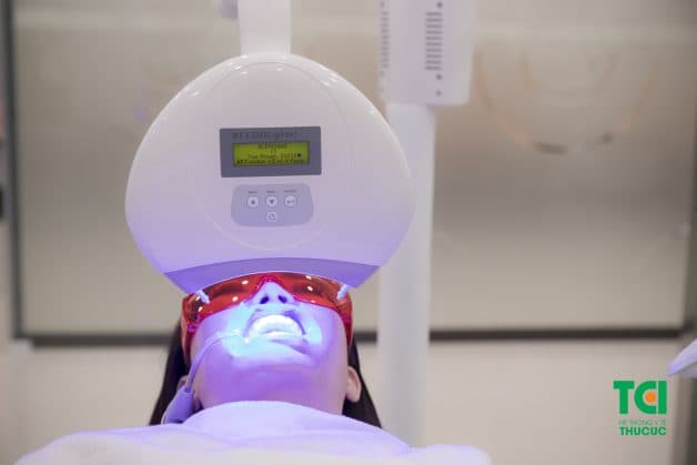 tẩy trắng răng Laser Whitening