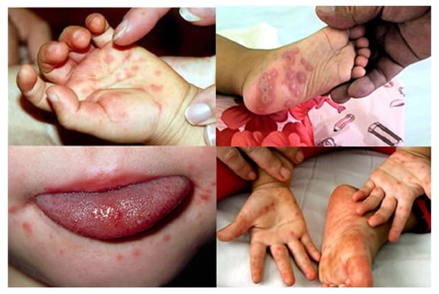 Bệnh tay chân miệng trẻ em có nguy hiểm không?