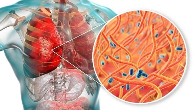 Nguyên nhân gây bệnh ho gà là gì