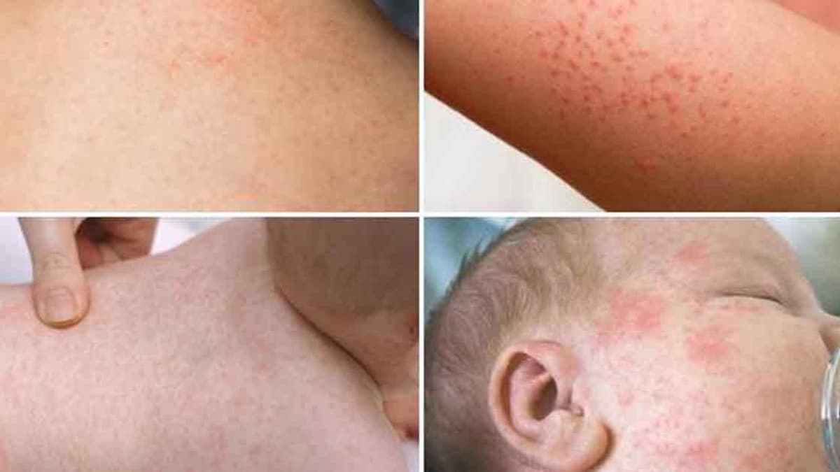 Hình ảnh các ban sởi trên cơ thể của trẻ