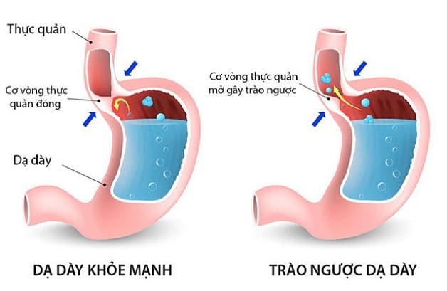 trào ngược dạ dày thực quản là bệnh tiêu hóa phổ biến