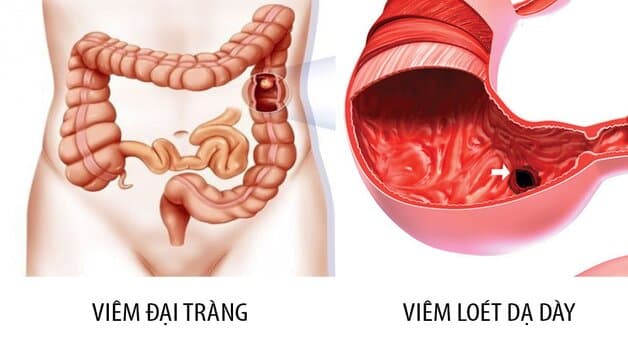Bệnh tiêu hóa thường gặp: viêm loét dạ dày, viêm loét đại tràng