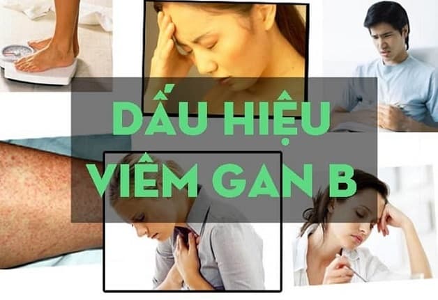 bệnh viêm gan B sống được bao lâu và triệu chứng bệnh
